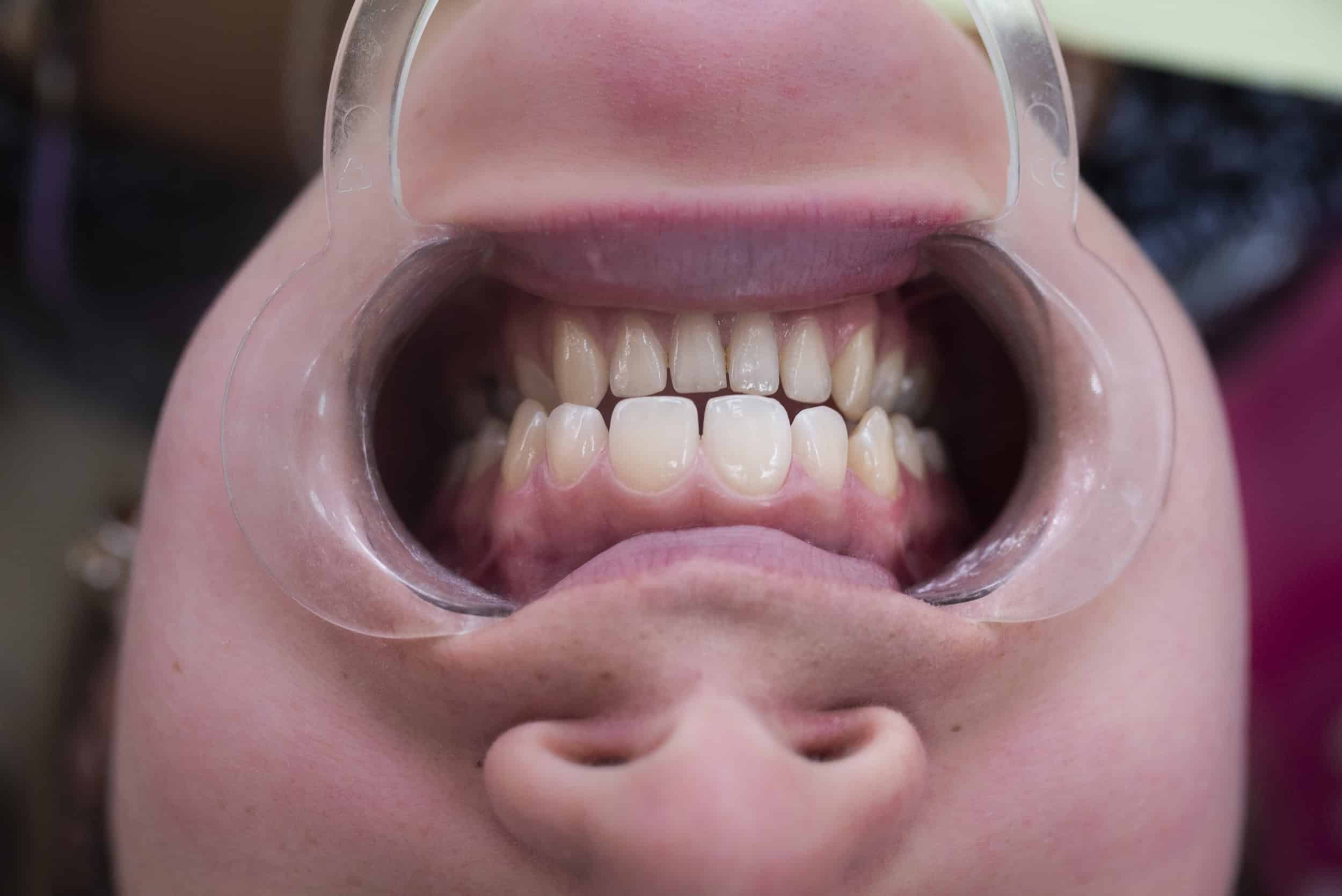 after dental infection treatment care Suwanee GA